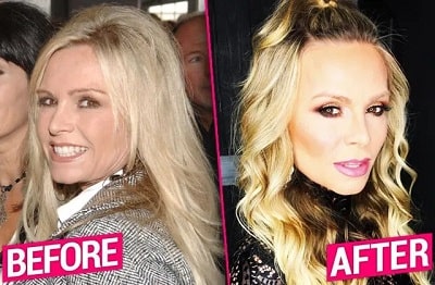 A picture of Tamra Judge before (left) and after (right) face lift.